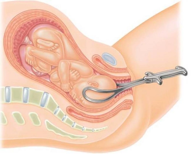 Hỗ trợ sinh bằng forceps